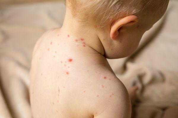 HSE warns parents of measles outbreak in Dublin City