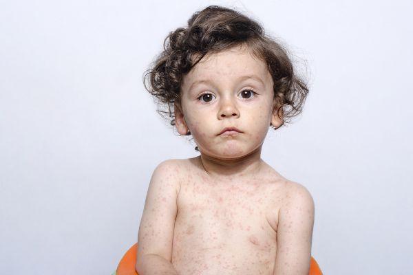 Measles cases highest in 20 years due to anti-vaccine movement, experts say
