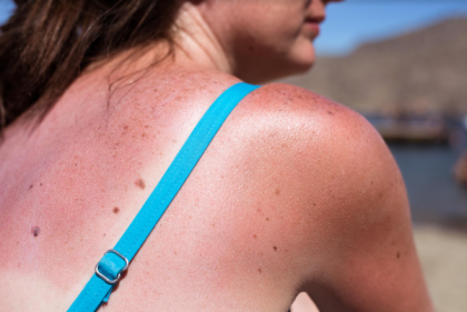 It’s Skin Cancer Awareness Month: The signs & symptoms to watch out for