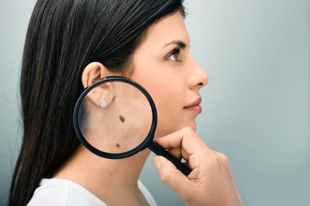 Top things to consider if you’re worried about a mole.