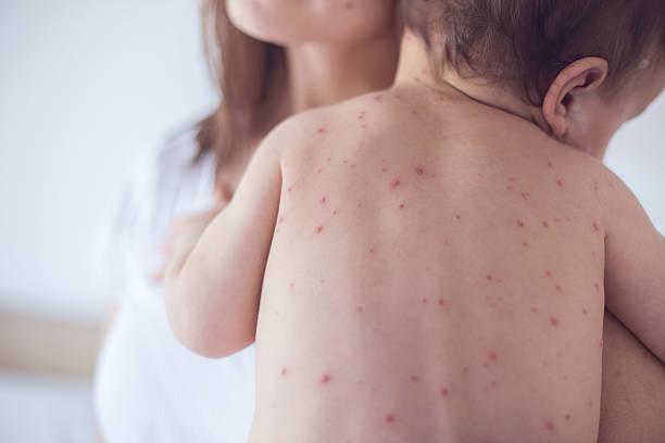 Expert Advice on chickenpox – a rite of passage or should you vaccinate?  