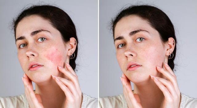 So you have rosacea: here are three products specifically developed to help calm & soothe