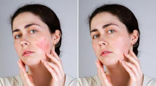 So you have rosacea: here are three products specifically developed to help calm & soothe