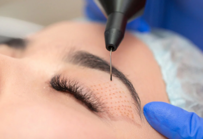 The popular Plasma Pen treatment is great alternative to eyelid surgery 