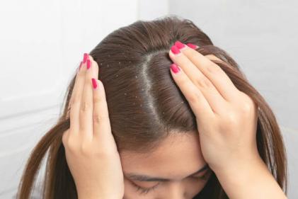 Suffering from dandruff that you cant quite crack with supermarket shampoos?  Help is at hand.