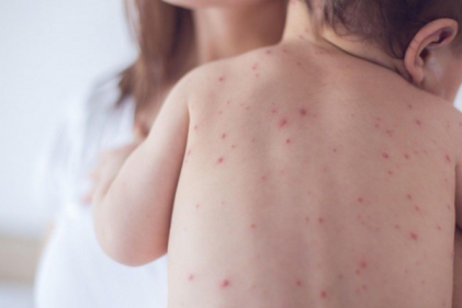 Our top tips to help you care for your child when they catch chickenpox