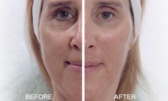 Find more about Visible Age Reverse, the one & only procedure that genuinely restores youthful skin