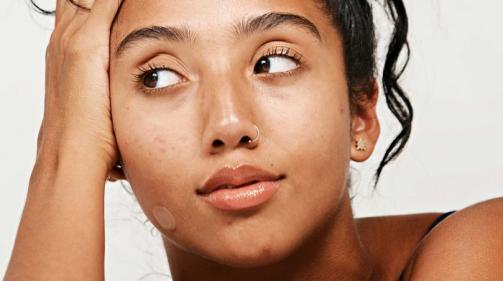 Survey reveals the impact of acne goes beyond skin despite love the skin youre in messages