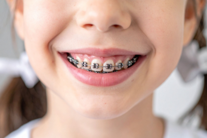 Five Signs Your Child May Need Braces