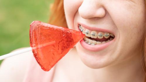 Five Foods to Avoid with Braces