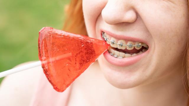 Five Foods to Avoid with Braces