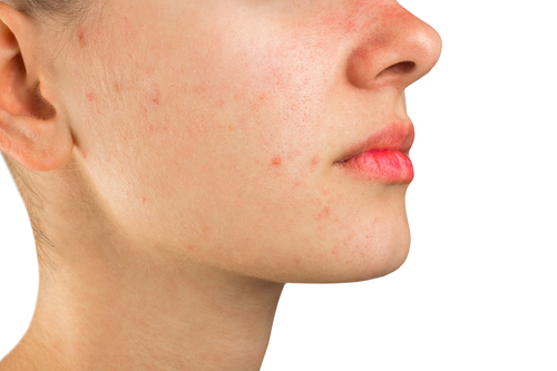 Natural ways to deal with acne scarring