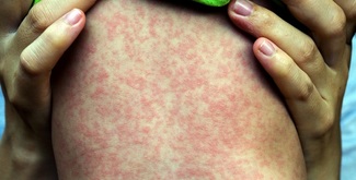 Measles: What you need to know 