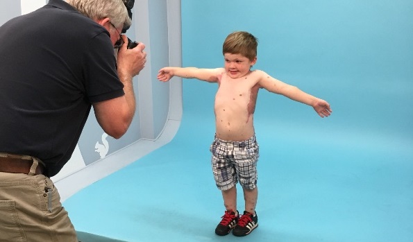 Boy, 4, gets ‘breast implants’ to help treat extremely rare...