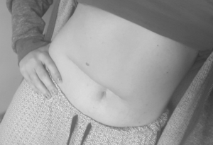 Living with Spina Bifida: Love your body, scars and all