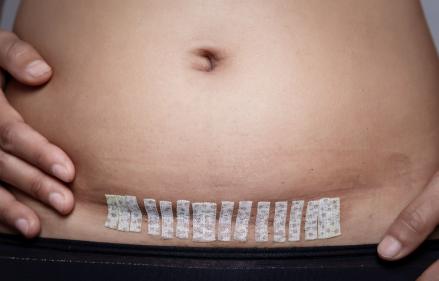 7 tips to survive a C-section