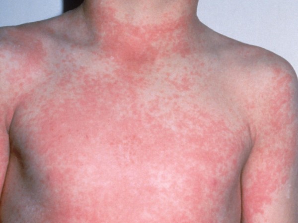 Scarlet fever - HSE.ie